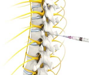 Spinal Injections 